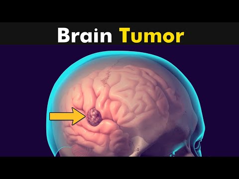What is Brain Tumor Surgery