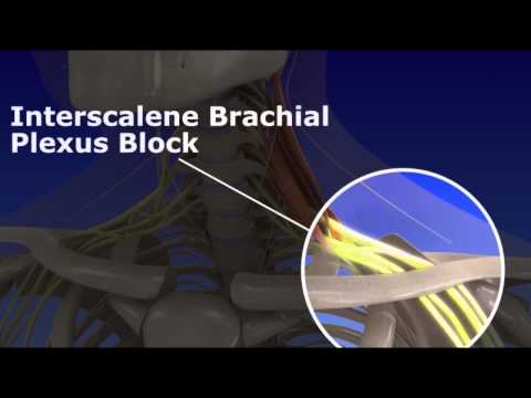 Interscalene Brachial Plexus Block