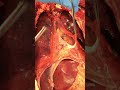 Autopsy The Opening Of The Pericardial Sac To Access The Heart