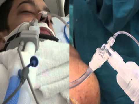 Monitoring Ventilation With Capnography