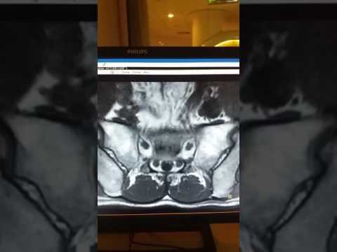 Collo miosite farmaco Come curare il mal di schiena