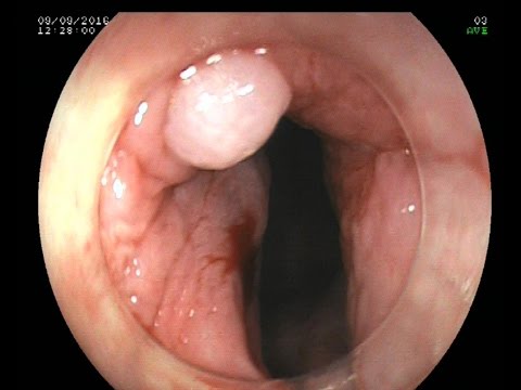 Klinikai diphyllobothriasis kép