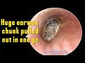 Huge Earwax Chunk Pulled Out In One Go ASMR Clean Relax Unwind
