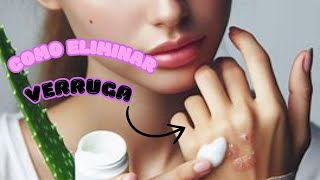 como remover verruga {tirar} Elimine uma verruga sem dor, de onde surgem as verrugas, quais são hpv
