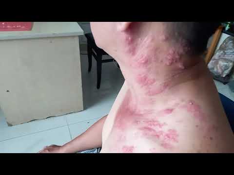 Thuốc Trị Giời Leo zona