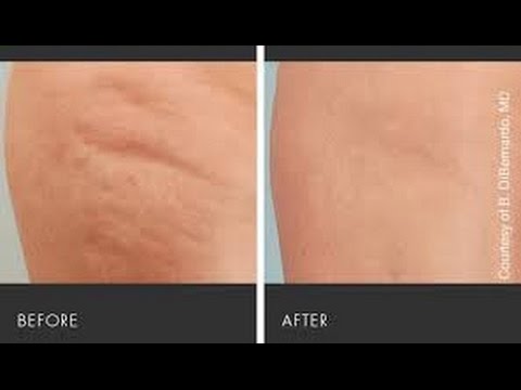 pourquoi j'ai de la cellulite