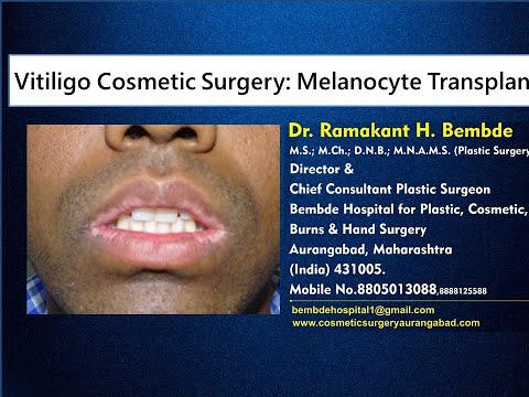 Melanocyte Transplant For White Patches On Lips