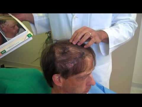 Hair Restoration for Burn Scar: Patient Transformation Revealed | Anthony Bared, MD, FACS Miami, FL
