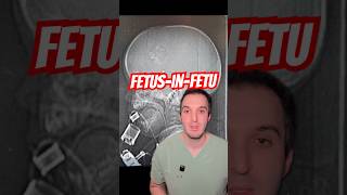 Incredible case of fetus-in-fetu