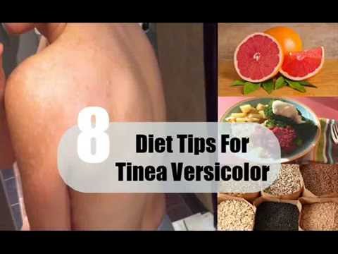 download lagu mp3 mp4 Diet Tips For Tinea Versicolor, download lagu Diet Tips For Tinea Versicolor gratis, unduh video klip Diet Tips For Tinea Versicolor
