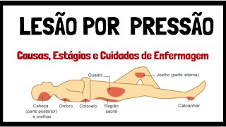 O que é Lesão por Pressão?  | Estágios da Lesão por Pressão