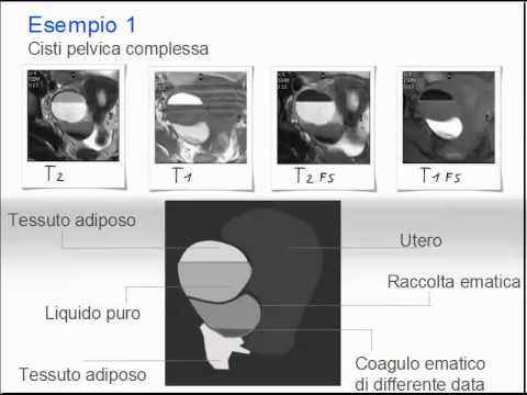 Una cura efficace per osteocondrosi cervicale-toracica Esercizio nel trattamento di ernia intervertebrale