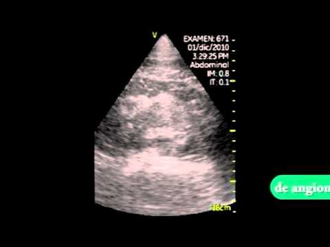 Perirenal Hematoma