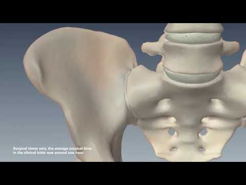 Diagnosing and Treating SI Joint Dysfunction: Mark Giovanini, MD