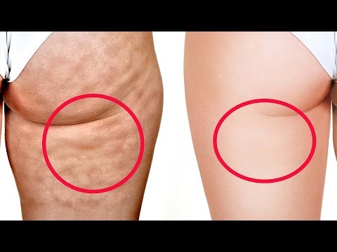 Kung paano alisin ang panloob na gilid Pinakamabilis na paraan upang mawala ang timbang