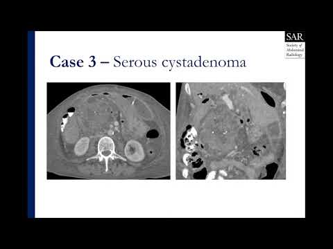 Solid and cystic pancreatic lesion