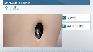 요추 디스크 절제술 미리보기