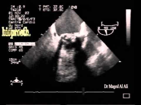 Multiple Small Thrombi On Mitral Bioprosthetic Valve