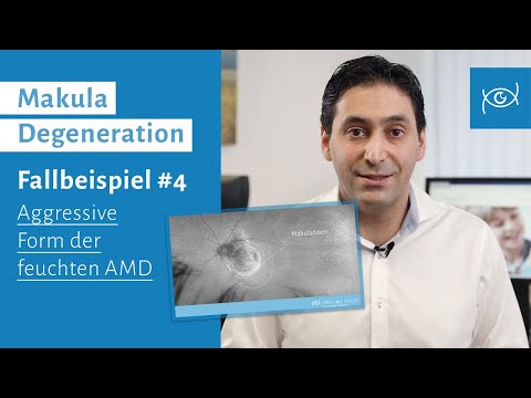 Augenerkrankung Makula Degeneration | Fallbeispiel | Stark chronische feuchte AMD: Sehkraft erhalten