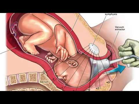Forceps Delivery: Process, Benefits, & Risks Forceps Delivery: Process, Benefits, & Risks