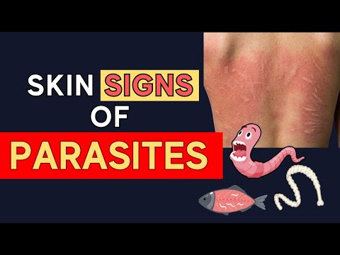 Surprising Parasite Skin Symptoms To Look For (That Can Be A Sign Of Gut Parasites)