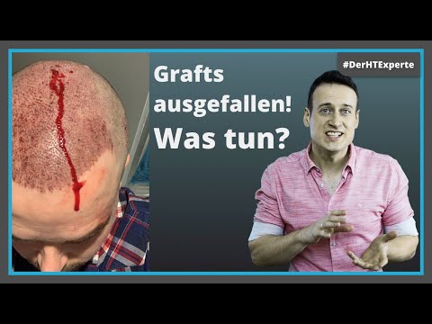 Hair transplant: When are the grafts fixed? [Crusts fall off with hair]