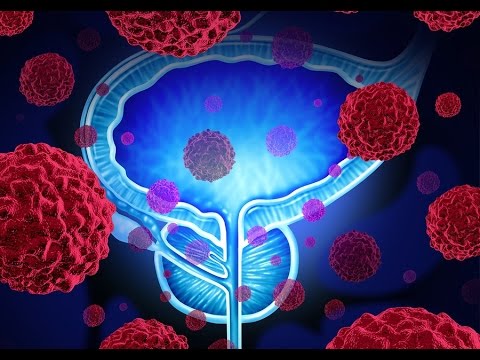 malysheva a prosztatitis kezeléséről prostatitis kezelés népi gyógymódok receptek