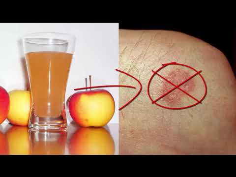 Gribok des Fusses und der Nägel die Merkmale Die Behandlung gribok die Candida der Nägel auf