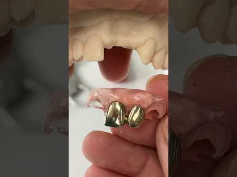 #Gold Flexi Partial @EnvisiontecMain #envisiontec #dental #teeth #smile #lsk121shorts #shortvideo