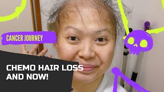 HAIR GROWTH AFTER CHEMOTHERAPY | #cancerawareness #hairgrowth #chemotherapy