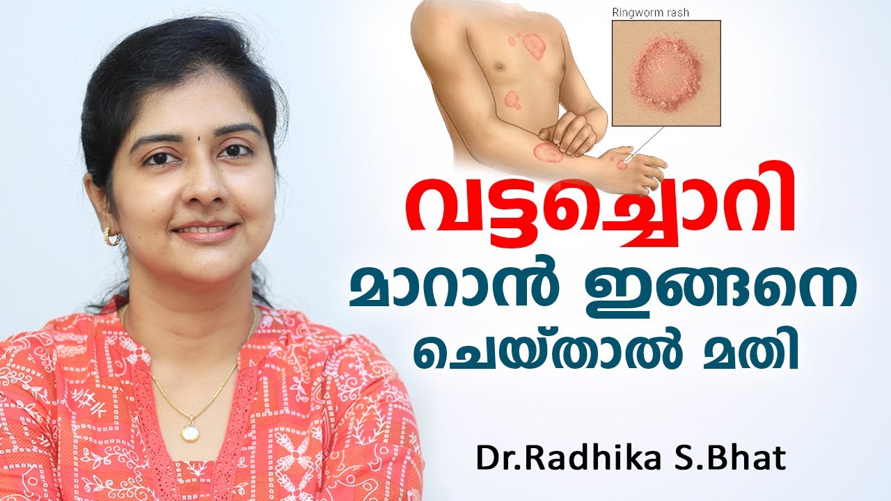 വട്ടച്ചൊറി മാറാൻ ഇങ്ങനെ ചെയ്താൽ മതി | Vattachori Maran Malayalam | Arogyam