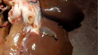 Disease clip - Liver fluke