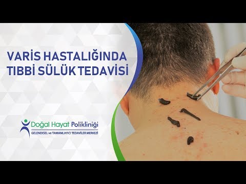Varis Hastalığında " Tıbbi Sülük Tedavisi"