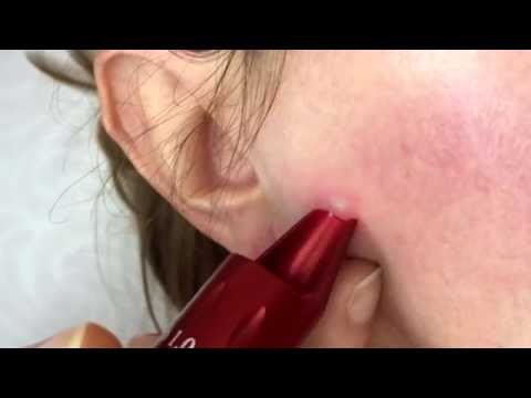 Aziks-derma da posti di pigmentary Riso a pigmentazione di pelle