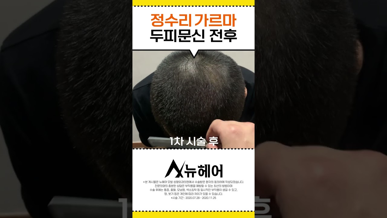 头顶上纹着头皮，头发看起来很多！ 前后后记公开 ㅣ New Hair