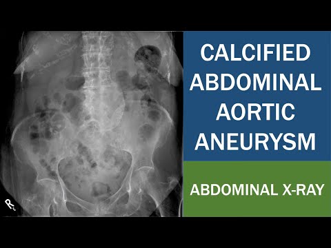 Calcified Abdominal Aortic Aneurysm in Abdominal X ray