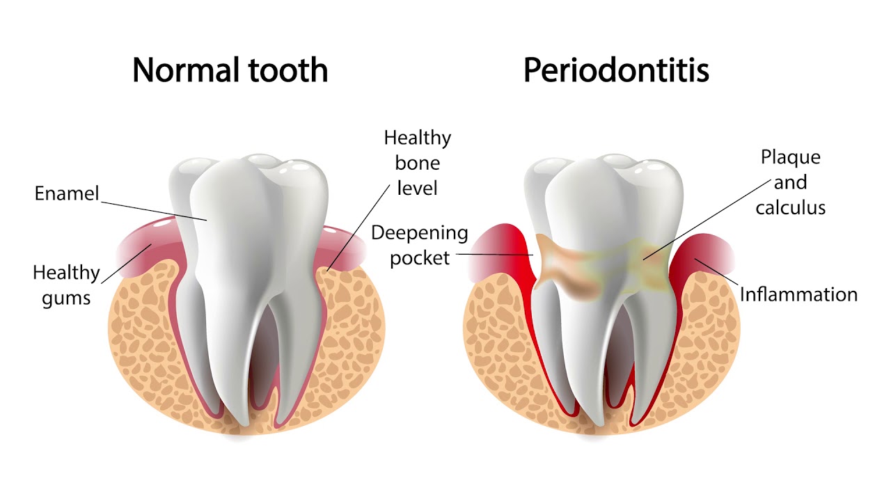 Model of tooth with gum disease compared to healthy tooth