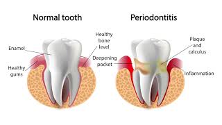 McCarl Dental Group Investigates: Signs of Gum Disease