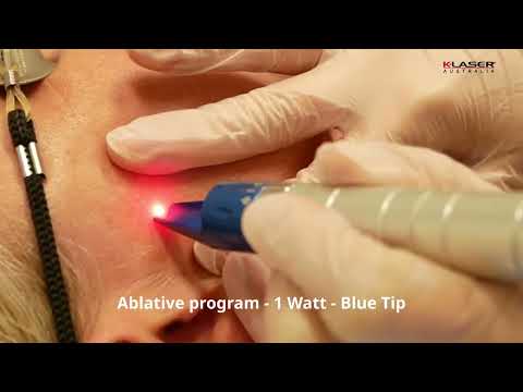 K-Laser Blue Derma - Carly Whytcross - Flat Seborrheic Keratosis