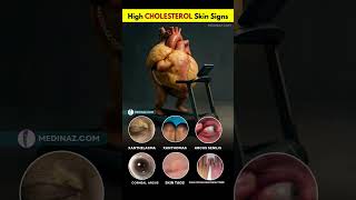High Cholesterol Skin Signs - What Your Body Is Trying to Tell You