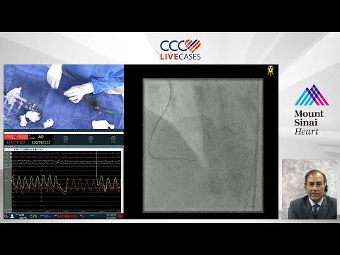 Staged PCI of RCA CTO using Antegrade/Retrograde Approach - November 2022
