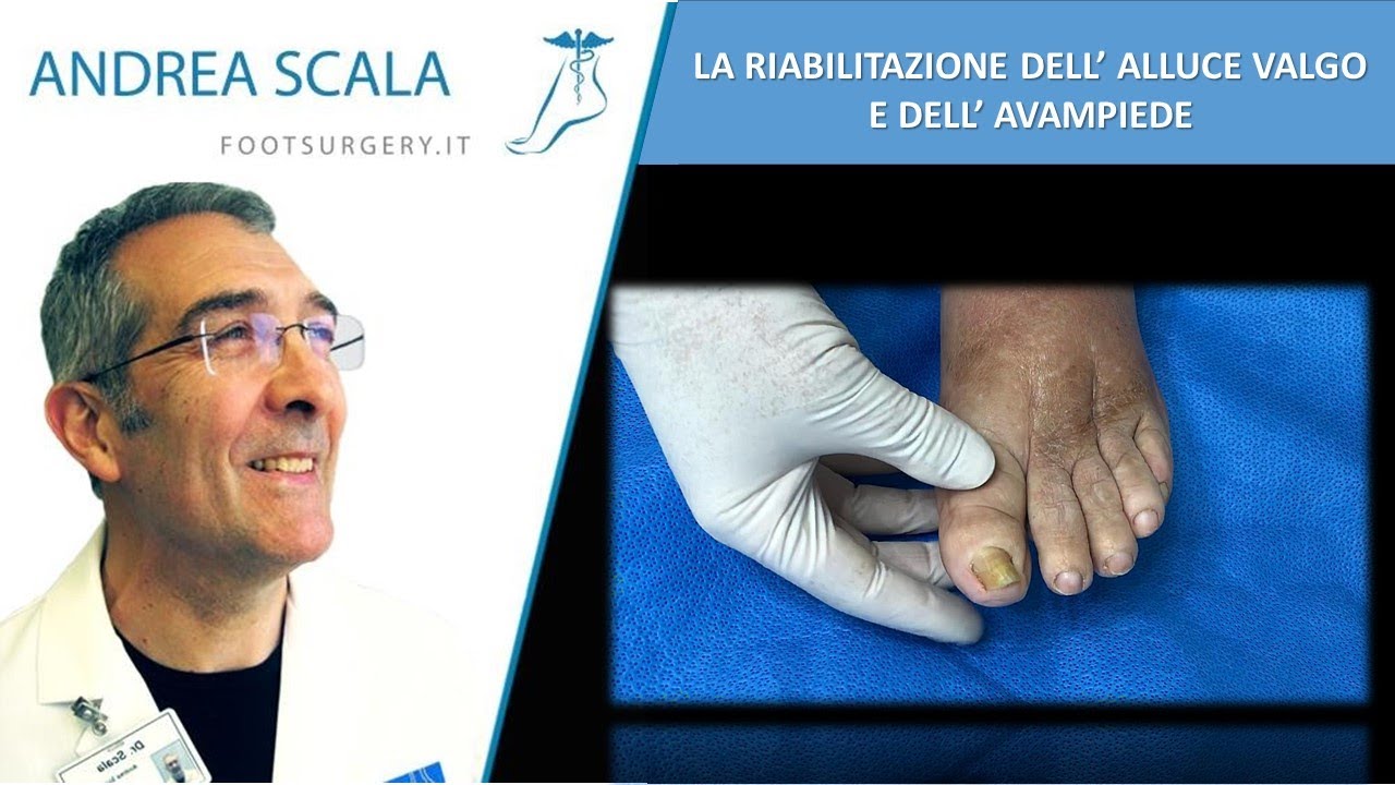 La riabilitazione dell'alluce valgo e dell'avampiede | Dott. Andrea Scala specialista della caviglia