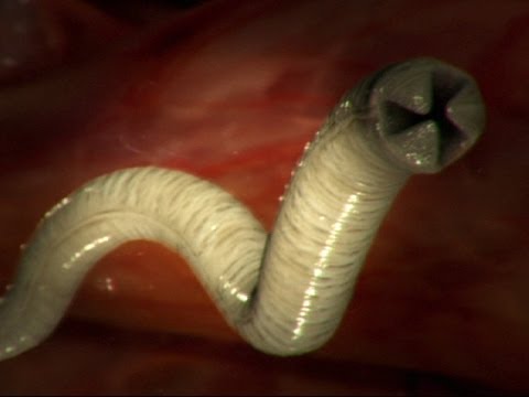 Ptsr un calla su helminths Come sgomberare uno stomaco di parassiti