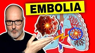 EMBOLIA PULMONAR: Síntomas, Causas, Prevención y Soluciones