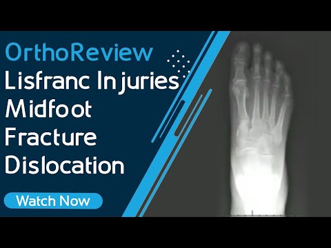 OrthoReview - Lisfranc Injuries | Midfoot Fracture / Dislocation