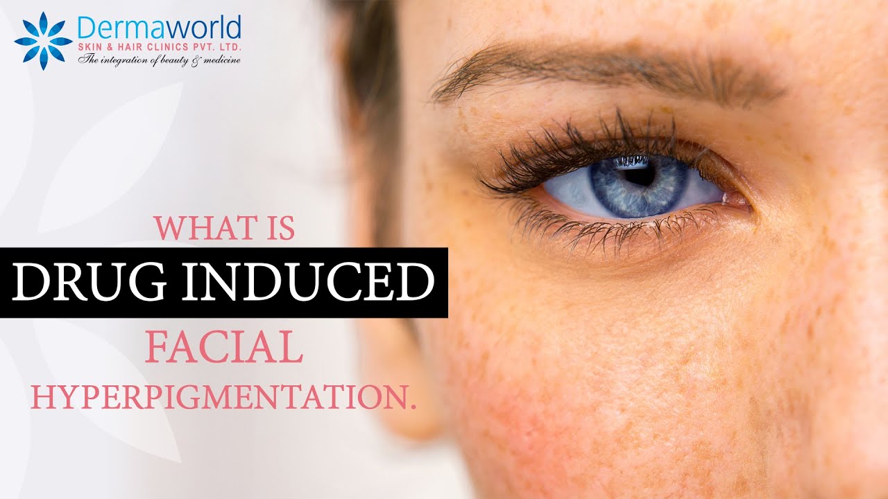 Drug Induced Facial Hyperpigmentation | Dr. Rohit Batra | Dermaworld Hair and Skin Clinic