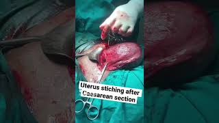 Download lagu Penjahitan operasi caesar | Operasi caesar #jahitan #simpul karang #jahitan #simpul #simpul bedah mp3