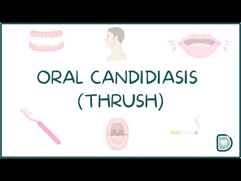 Understanding Oral Candidiasis or Oral Thrush