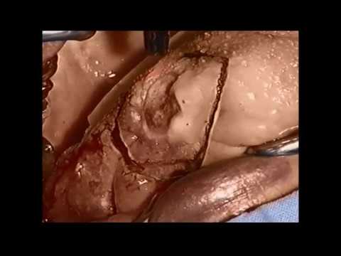 MCO 25plus – Tongue leukoplakia resection