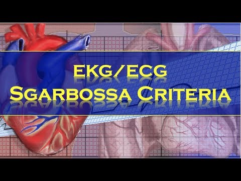 Sgarbossa Criteria Explained